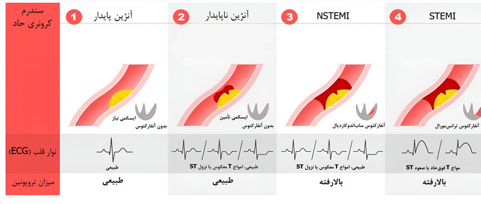 انواع سکته قلبی