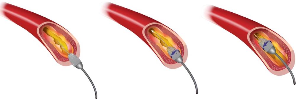 درمان سکته قلبی با آترکتومی