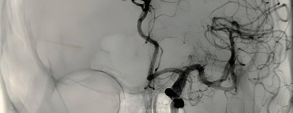 تشخیص سکته قلبی با آنژیوگرافی