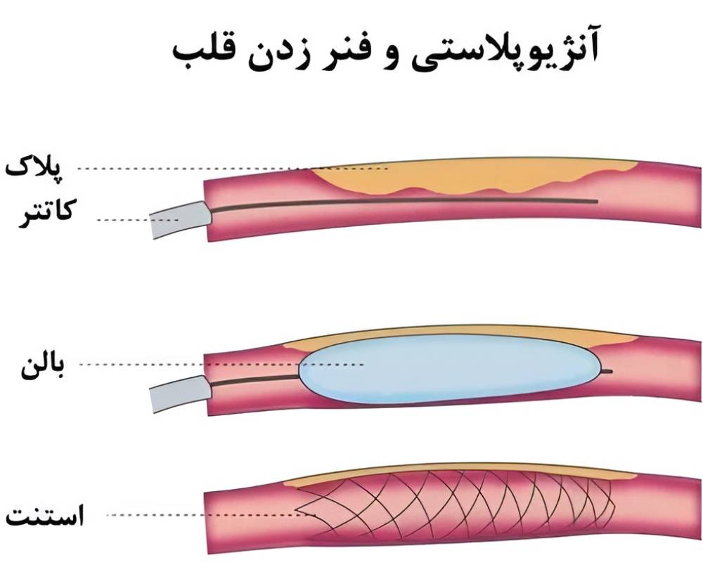 تفاوت میان آنژیوپلاستی با استنت و بالن قلب چیست؟