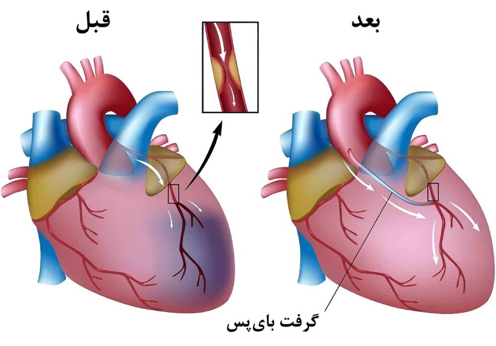 جراحی بای‌پس برای درمان سکته قلبی