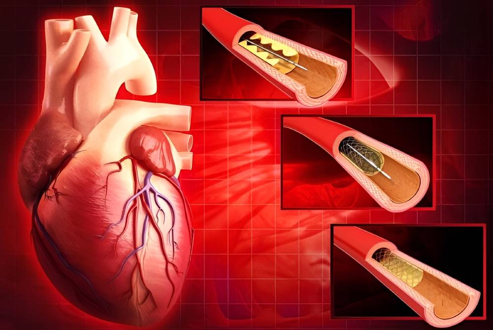 فنر زدن قلب یا استنت قلب