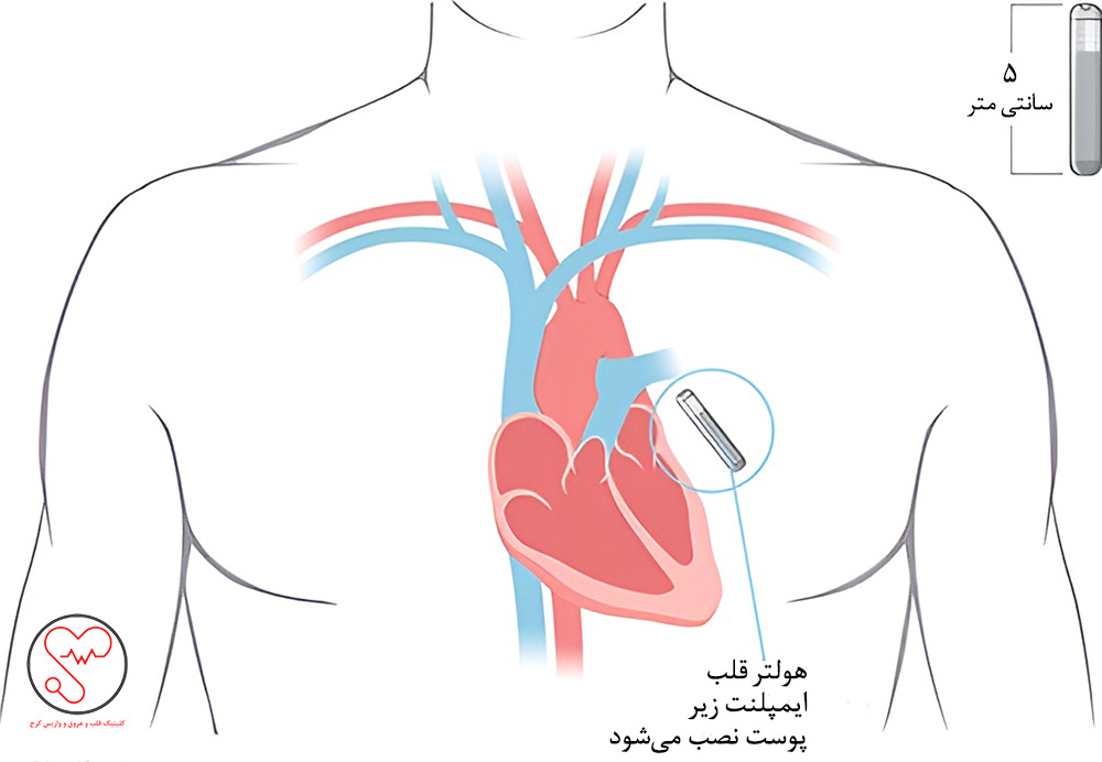 هولتر قلب قابل کاشت (ایمپلنت)