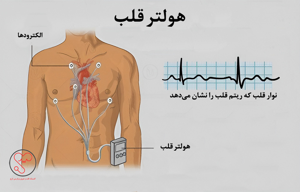 نحوه بستن هولتر قلب