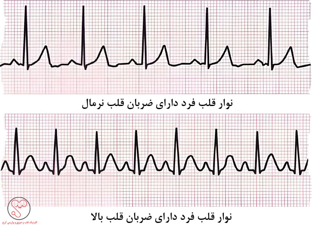 منظور از ضربان قلب بالا چیست