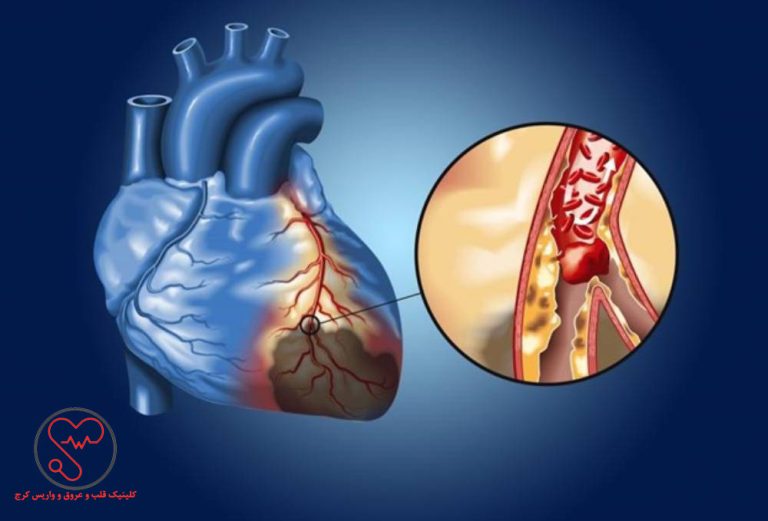 علائم گرفتگی عروق قلب در زنان و مردان