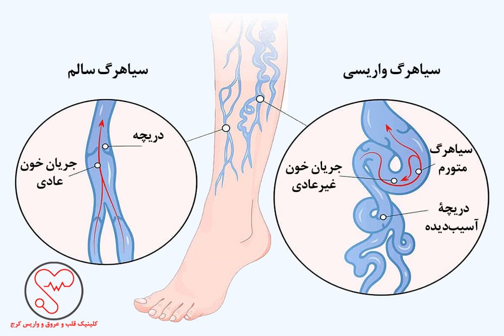 واریس و چگونگی آن