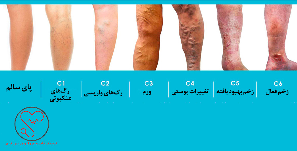 مراحل شدت واریس و پیشرفت آن