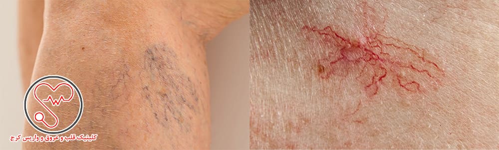 رگ‌های عنکبوتی یا شبکه‌ای قرمز یا آبی 