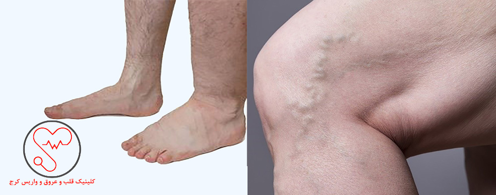 رگ‌های واریسی برجسته