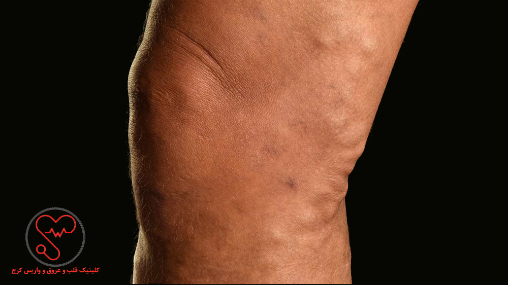 واریس همراه با درد و ورم پا