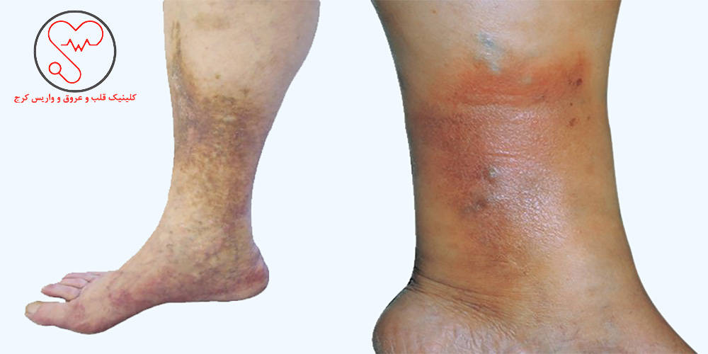 واریس و خشکی و پوسته شدن پا