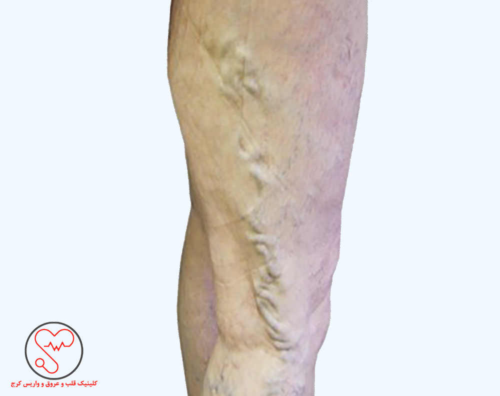 واریس طنابی یا شاخه‌ای