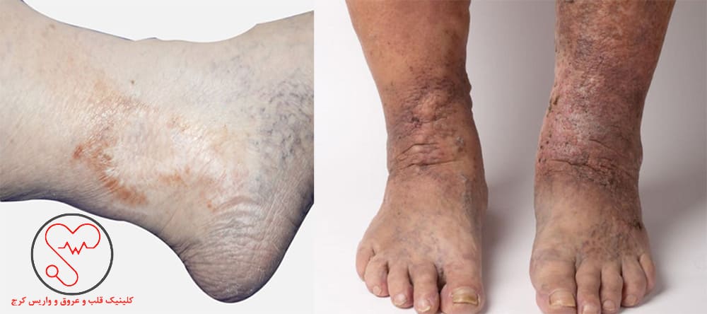 زخم عروقی پایین پا یا دور مچ پا 