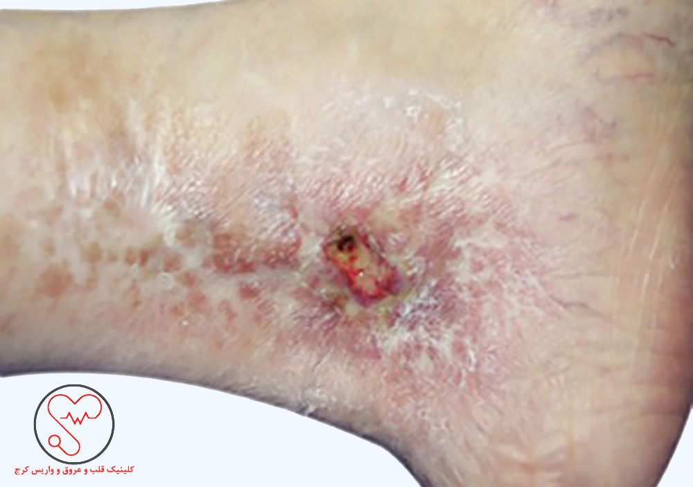 زخم عروقی پا