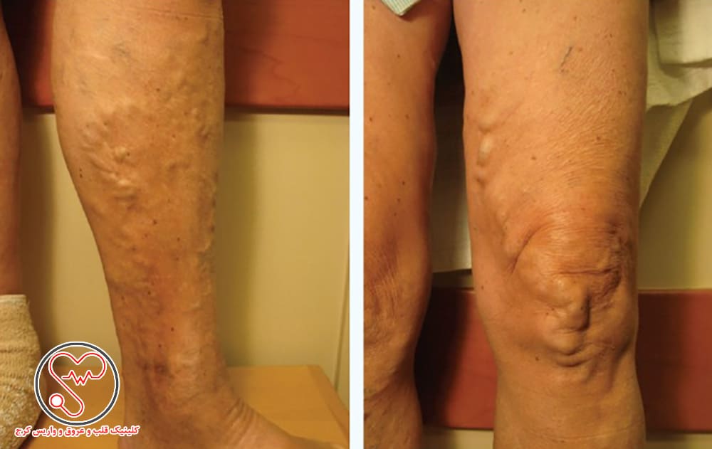 واریس صافن بزرگ