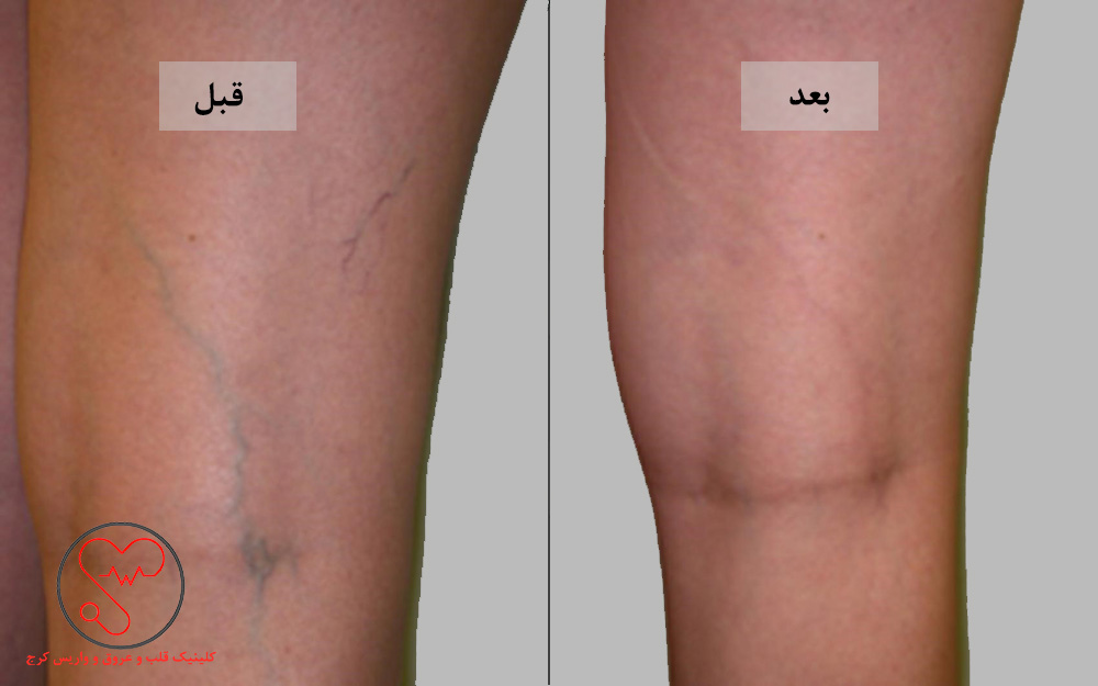 درمان واریس با اسکلروتراپی