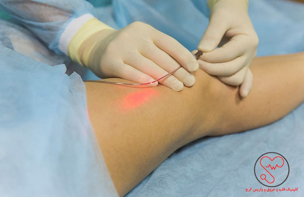 لیزر درمانی و درمان واریس