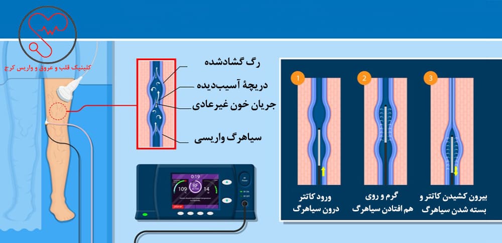 دستگاه آراف جهت درمان واریس