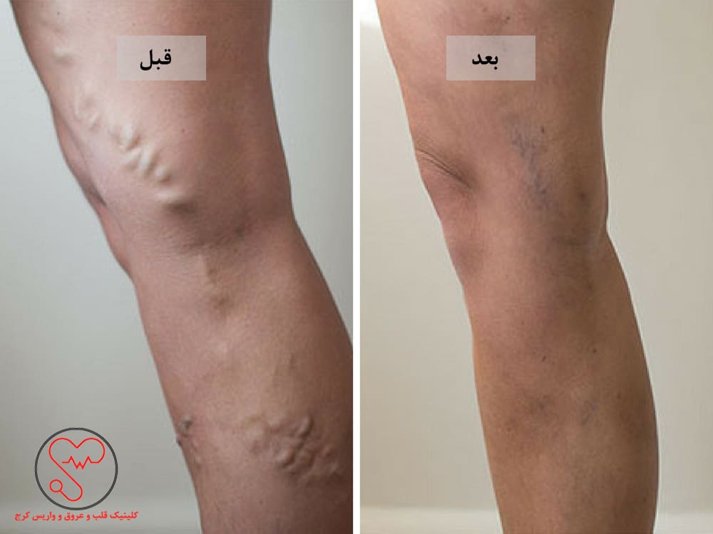 درمان با دستگاهRF