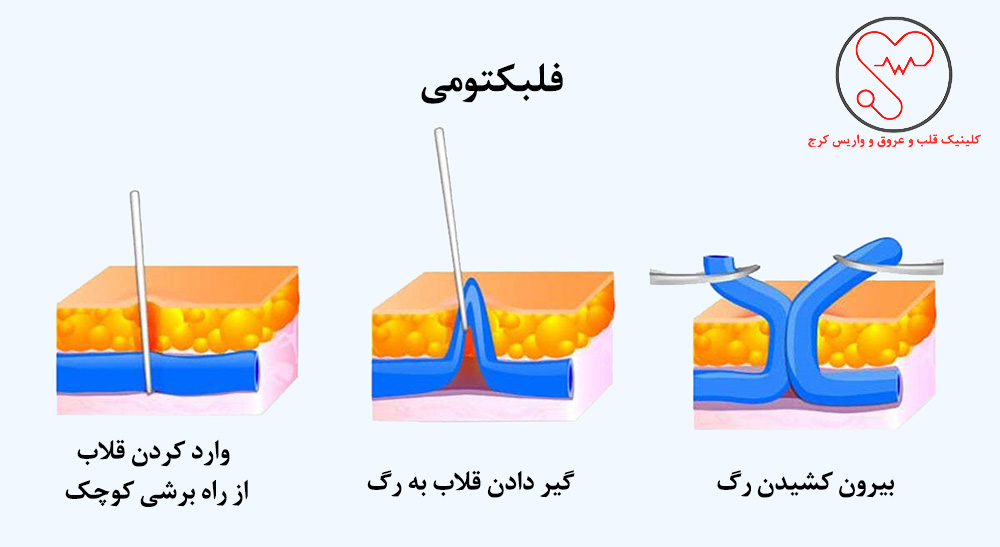 بستن رگ واریسی یا لیگاسیون و استریپینگ 