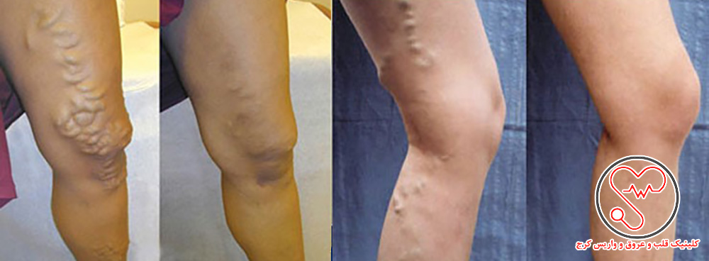 واریس صافن کوچک