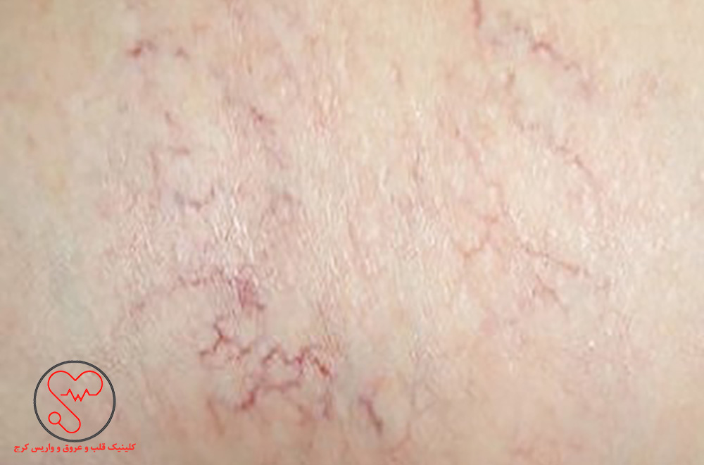 واریس عنکبوتی